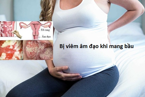 bị v,iêm âm đ.ạo khi đang có bầu