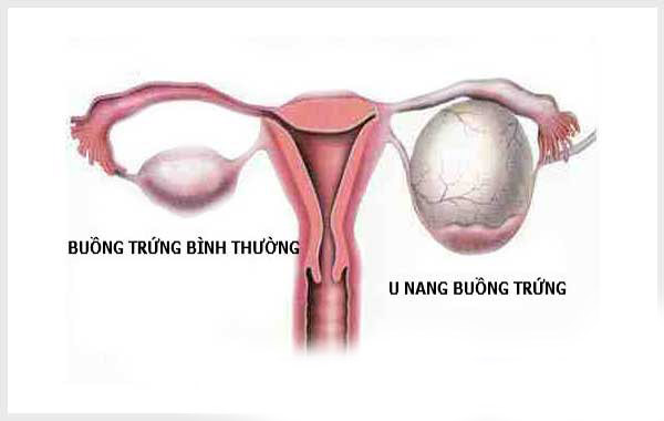 Hệ thống nội soi cổ tử cung Storz - Khiến bệnh buồng trứng “rời xa” phái đẹp 2