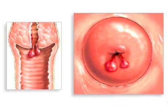hình ảnh của bệnh polyp cổ tử cung