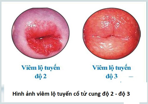 hình ảnh viêm lộ tuyến cổ tử cung theo từng giai đoạn