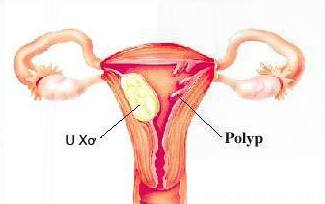 Những điều cần biết về bệnh polyp tử cung 