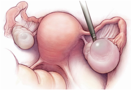 Cách phòng ngừa bệnh u nang buồng trứng tái phát 