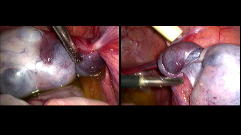 phẫu thuật cắt bỏ u nang buồng trứng
