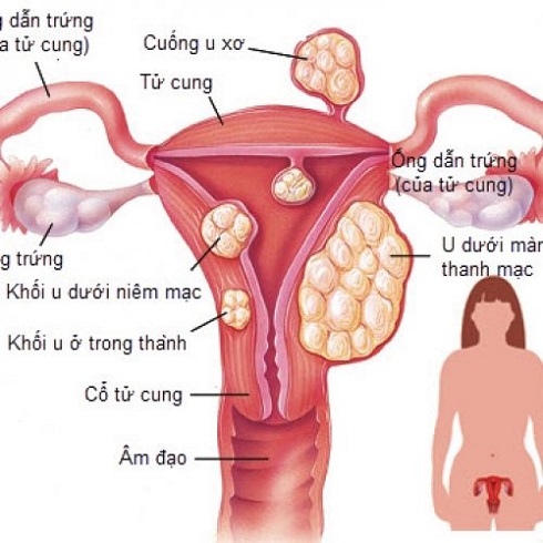 Bệnh u xơ tử cung ở nữu giới là gì ?