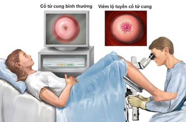 chữa viêm lộ tuyến cổ tử cung cấp độ hai ở phòng khám đa khoa Bắc Ninh