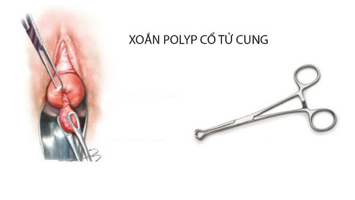 xoắn polyp ở cổ tử cung