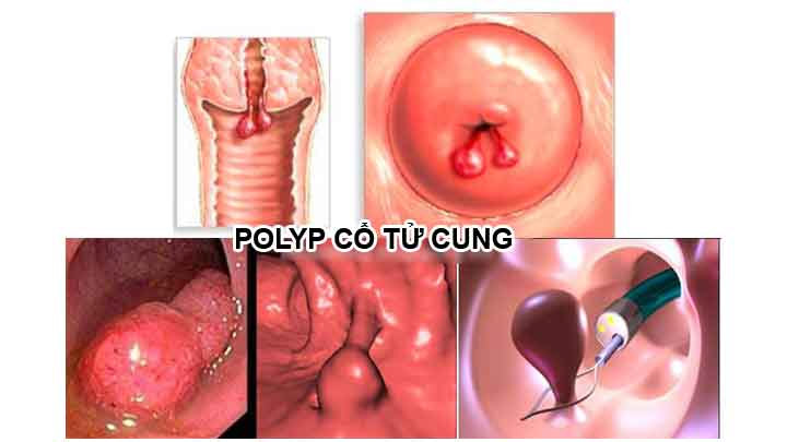 Tìm hiểu bệnh polyp cổ tử cung