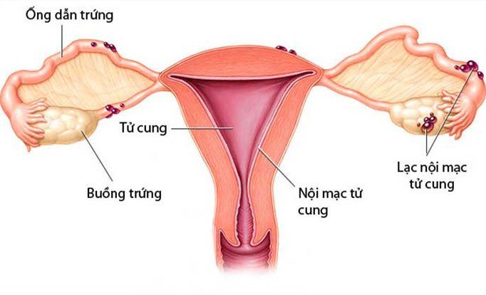 Hiểu về cơ thể bạn: nội mạc tử cung