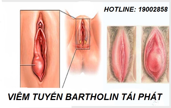 Viêm tuyến bartholin tái phát