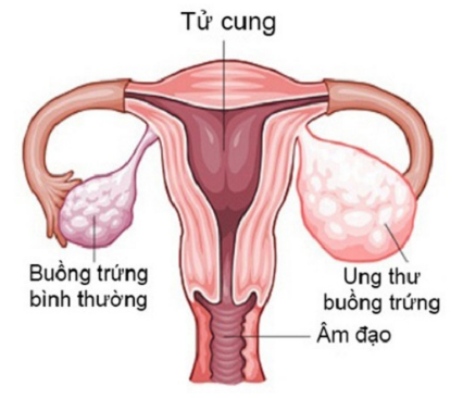 Chữa u nang buồng trứng ở đâu tốt tại Bắc Ninh?