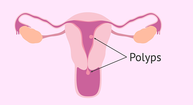 Những điều chị em cần biết về Polyp cổ tử cung
