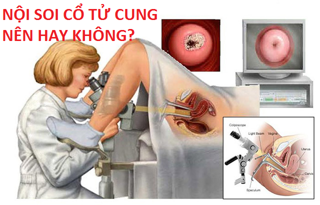 Nội soi cổ tử cung chỉ 250 nghìn tại Bắc Ninh