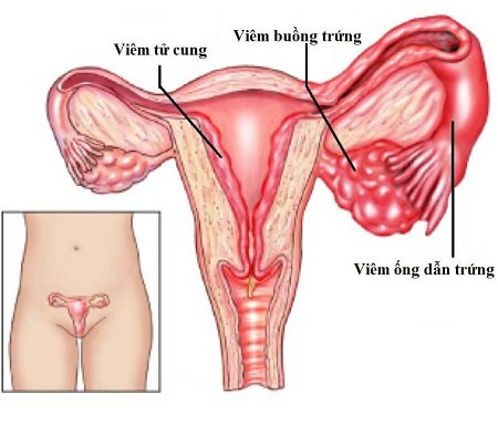Điểm mặt những nguyên nhân gây nên viêm buồng trứng ở nữ giới
