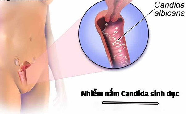 Bệnh nấm Candida ở bộ phận sinh dục nam và nữ